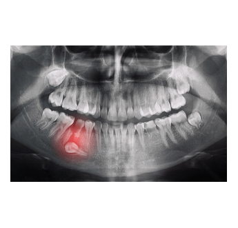 Dental X-ray showing an impacted tooth